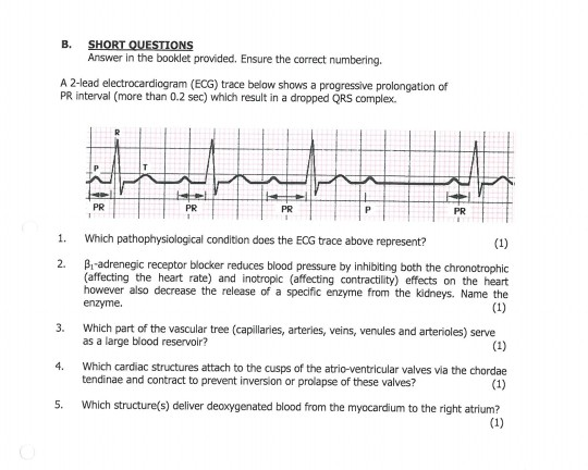 B. SHORT QUESTIONS Answer in the booklet provided. Ensure the correct numbering. A 2-lead electrocardiogram (ECG) trace below