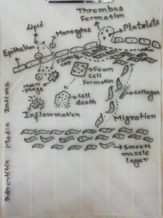Thrembus formation Lipid Monogyntes Platelets Tof fcam D > foam SCOR VE . Formation A Intima scell * Inflammation : collagen