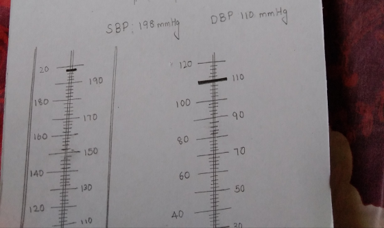 DBP 110 mm Hg SBP: 198 mm Hg
