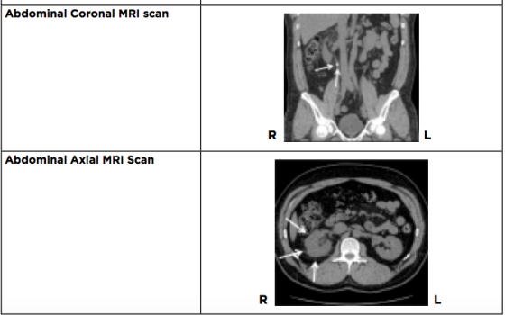 Abdominal Coronal MRI scan Abdominal Axial MRI Scan