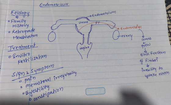 Endometriosis Etiology o family History o Retrograde antity Endometrium Uterus & Endometos M Menstruahon tovary comes Treatme