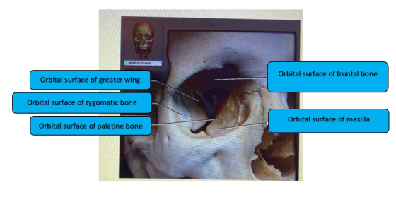 BONE FEATURES Orbital surface of frontal bone Orbital surface of greater wing Orbital surface of zygomatic bone Orbital surfa
