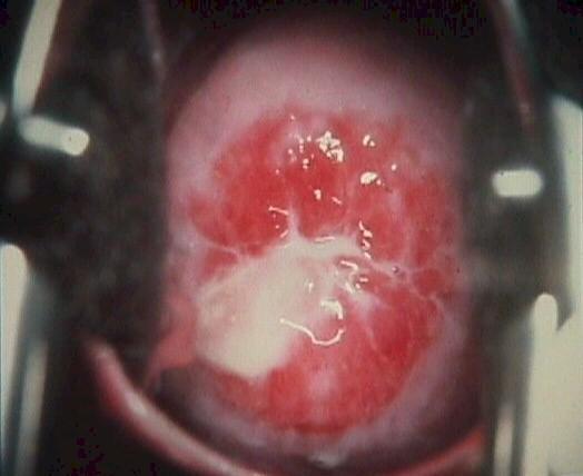 Image result for chlamydia pelvic exam
