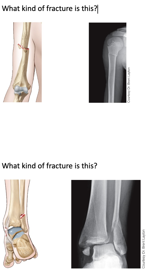 What kind of fracture is this Courtesy Dr. Brent Layton What kind of fracture is this? Courtesy Dr. Brent Layton