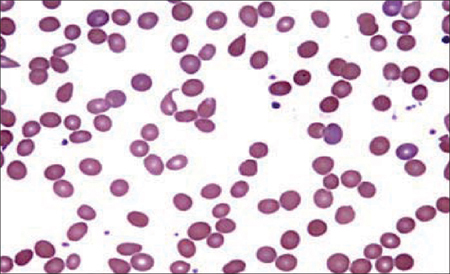 Image result for blood smear Rh hemolysis