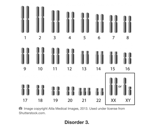 iiii 1 2 3 4 5 6 7 8 9 10 11 12 13 14 15 16 or 17 18 19 20 21 22 XX XY 0 Image copyright Alila Medical Images, 2013. Used und