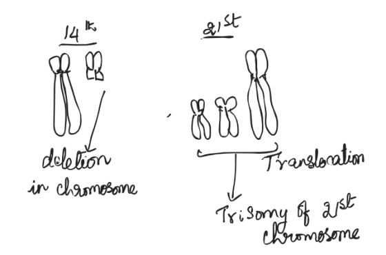 K 14 21st 23 BE delelor in chromosome Trendboration T Trisomy of ast chromosome