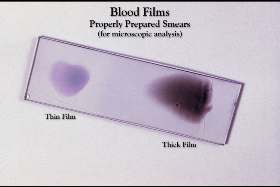 Blood Films Properly Prepared Smears (for microscopic analysis) Thin Film Thick Film