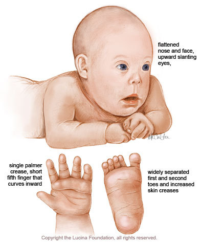 flattened nose and face, upward slanting eyes, single palmer crease, short fifth finger that curves inward widely separated f