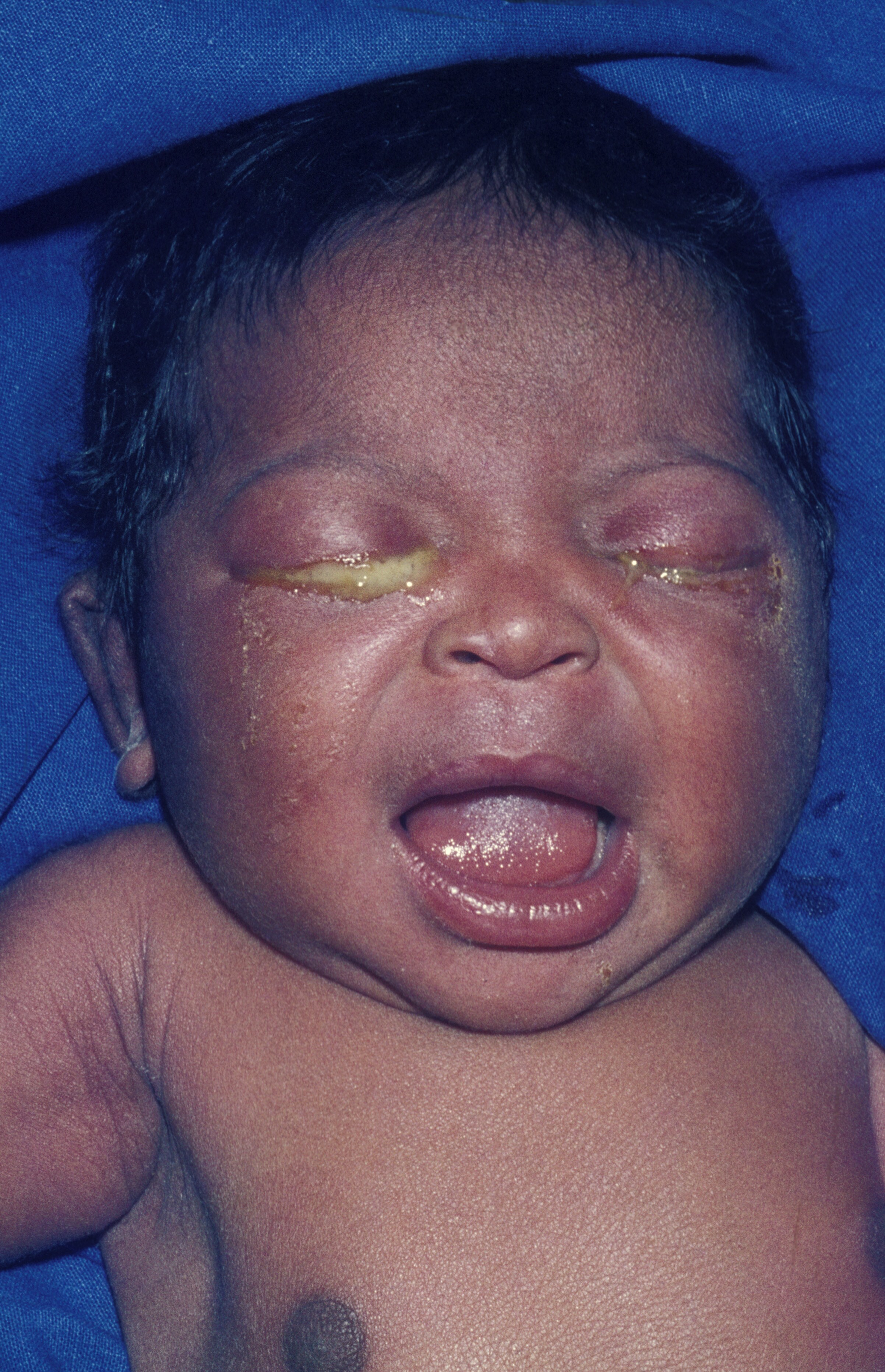 Image result for bacterial conjunctivitis pediatric"