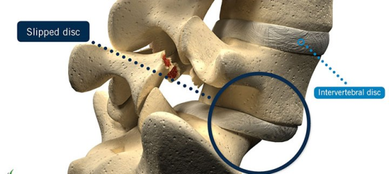 Slipped disc Intervertebral disc