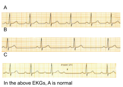 Wichtbart الب لے المال In the above EKGs, A is normal