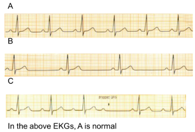 المالي الحالي إلى مال من المال In the above EKGs, A is normal