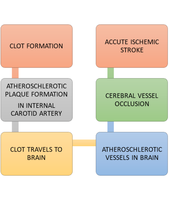 CLOT FORMATION ACCUTE ISCHEMIC STROKE ATHEROSCHLEROTIC PLAQUE FORMATION IN INTERNAL CAROTID ARTERY CEREBRAL VESSEL OCCLUSION