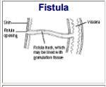 Fistula hvea Sin- isu pare may bead