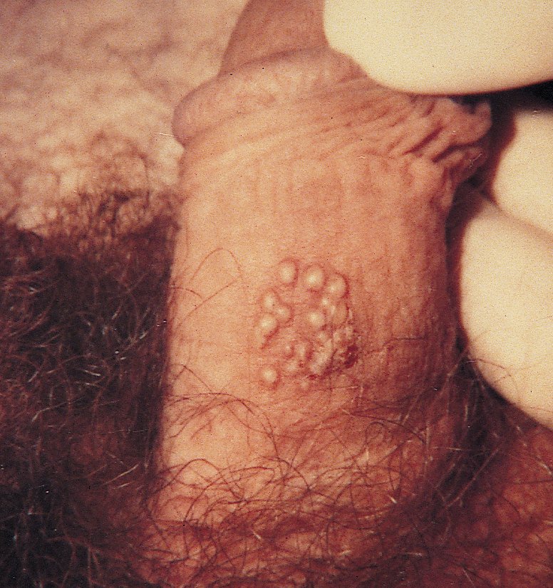 Image result for genital herpes penis