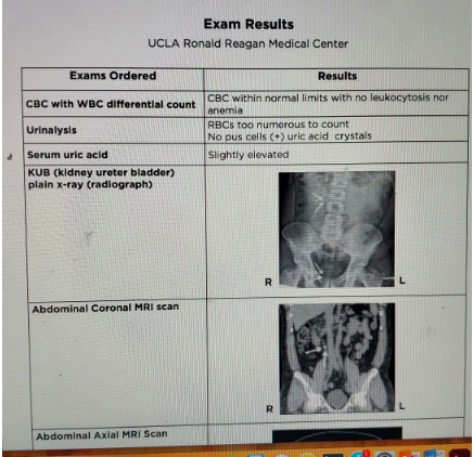 Exam Results UCLA Ronald Reagan Medical Center Exams Ordered CBC with WBC differential count Results CBC within normal limits