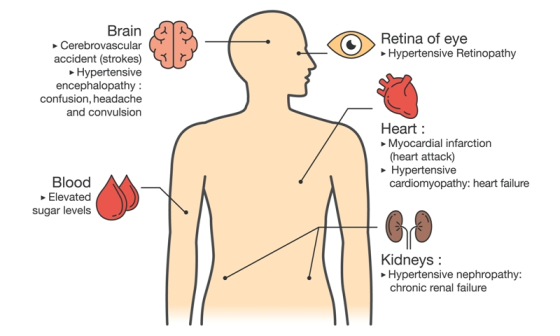 Retina of eye Hypertensive Retinopathy Brain Cerebrovascular accident (strokes) Hypertensive encephalopathy: confusion, heada
