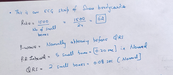 bones This is an ECG strip of sinus bradycardia No. of small 24 - 262) I-wave Nanually appearing before QRS PR Internal = 5 s