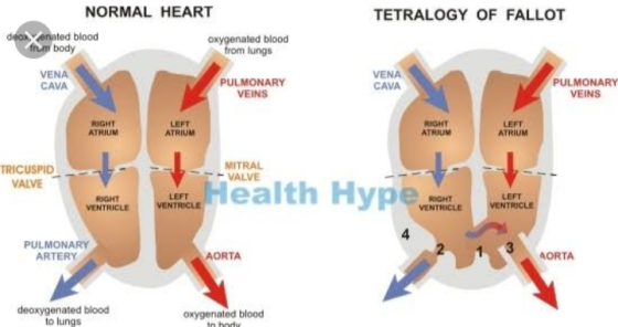 NORMAL HEART TETRALOGY OF FALLOT enated blood oxygenated blood from lungs frem body VENA CAVA VENA CAVA PULMONARY VEINS PULMO
