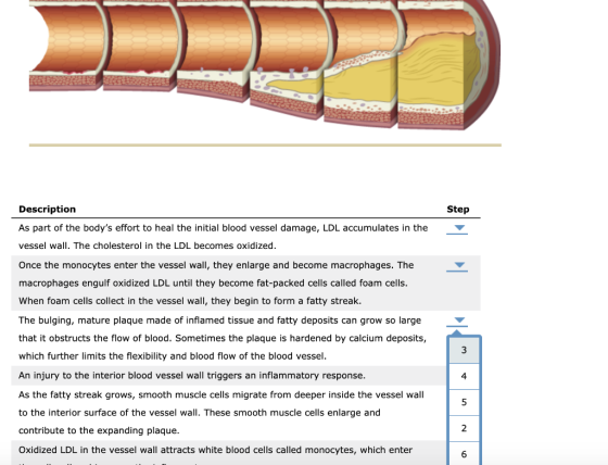 Step Description As part of the bodys effort to heal the initial blood vessel damage, LDL accumulates in the vessel wall. Th