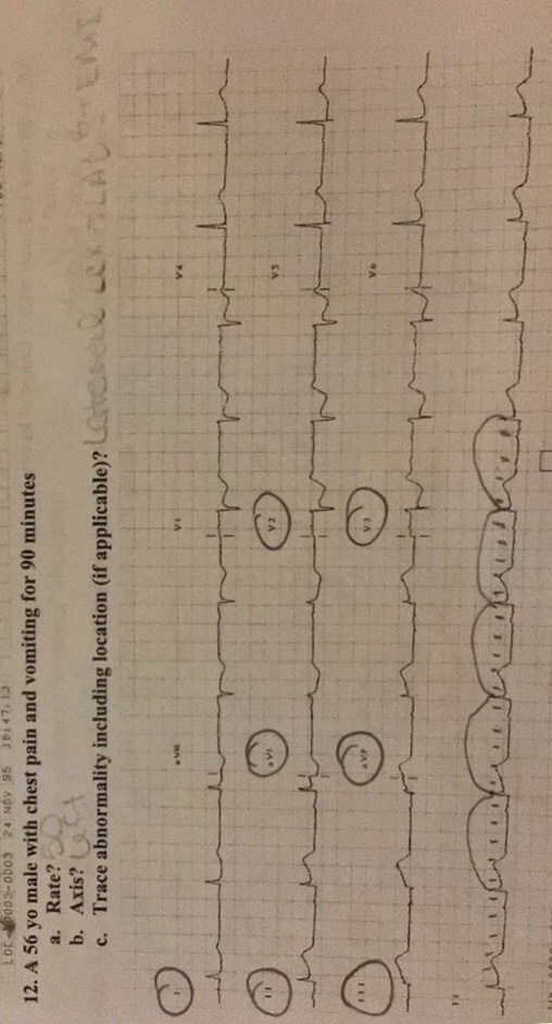 LOC-10003-000324 NOV 95 3614713 12. A 56 yo male with chest pain and vomiting for 90 minutes a. Rate? b. Axis? c. Trace abnor