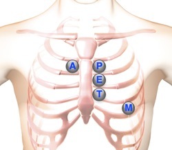 heart murmur sounds auscultation location areas