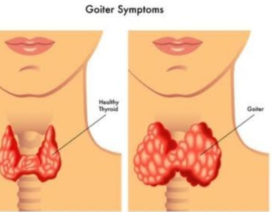 Goiter Symptoms Healthy Thyroid Goiter