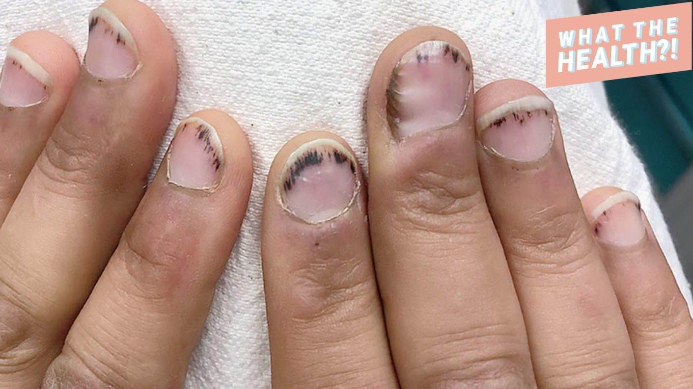 Image result for splinter hemorrhages nails pictures