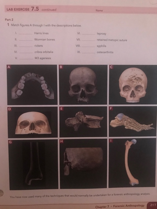 LAB EXERCISE 7.5 continued Part 2 1 Match figures A through I with the descriptions below. Harris lines Wormian bones rickets