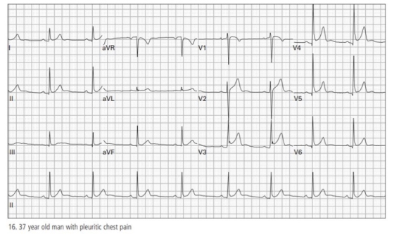 uu i thu 2 aVR V1 V4 ПИЛ u aVL V2 V5 u 111 aVF V3 V6 th hhh 11 16. 37 year old man with pleuritic chest pain