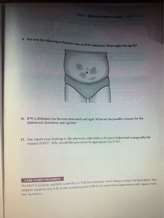A DICAL CARESSE 9. You note the following ecchymotic aresow on B.Ws abdomen. What might this signify? s abdomen. What mig 1