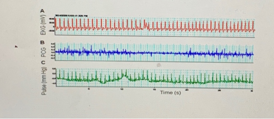 Pulse (mm Hg) O PCG W EKG (mv) ► Time (s)
