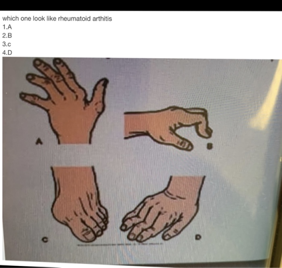 which one look like rheumatoid arthitis 1.A 2.B 3.C 4.D