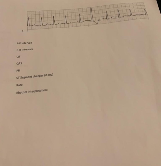P-P Intervals R-R Intervals от QRS PR ST Segment changes (if any) Rate Rhythm Interpretation: