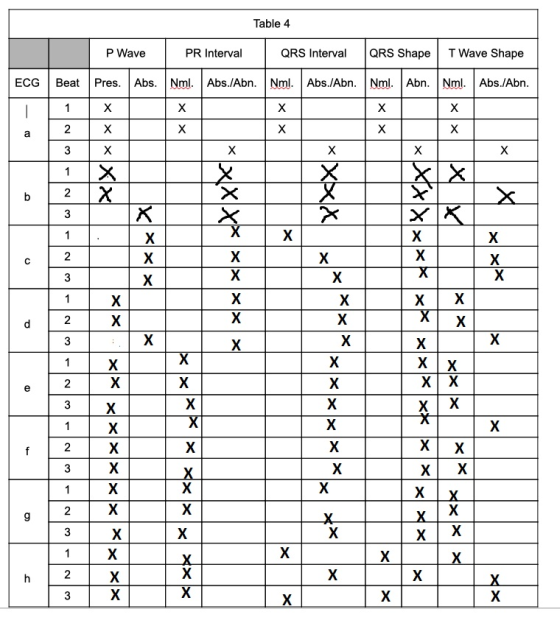 Table 4 P Wave PR Interval QRS Interval QRS Shape T Wave Shape ECG Beat Pres. Abs. Nml. Abs./Abn. Nml. Abs./Abn. Nml. Abn. Nm