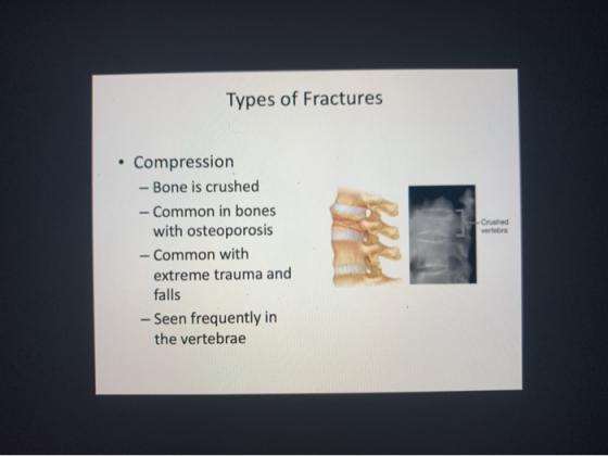 Types of Fractures Crushed vertebra • Compression - Bone is crushed - Common in bones with osteoporosis - Common with extreme