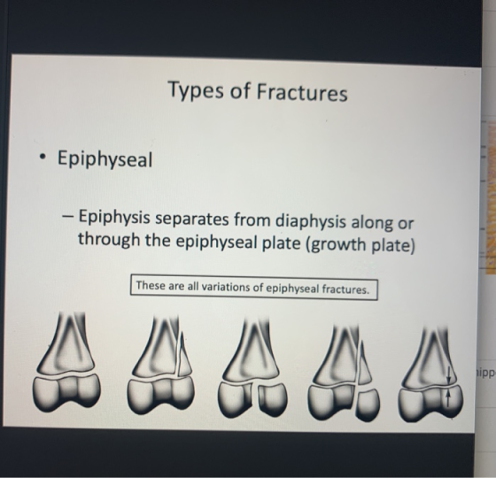 Types of Fractures Epiphyseal - Epiphysis separates from diaphysis along or through the epiphyseal plate (growth plate) These