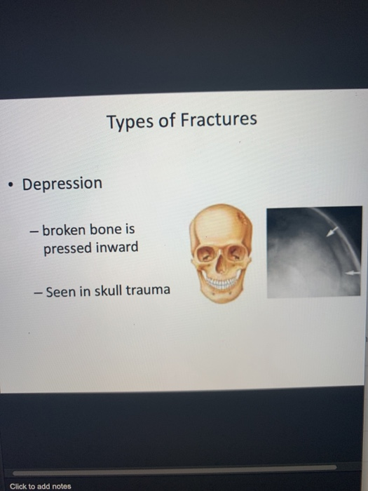 Types of Fractures Depression - broken bone is pressed inward – Seen in skull trauma Click to add notes