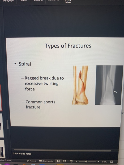 Paragraph USUI Ideas Types of Fractures • Spiral - Ragged break due to excessive twisting force - Common sports fracture Clic