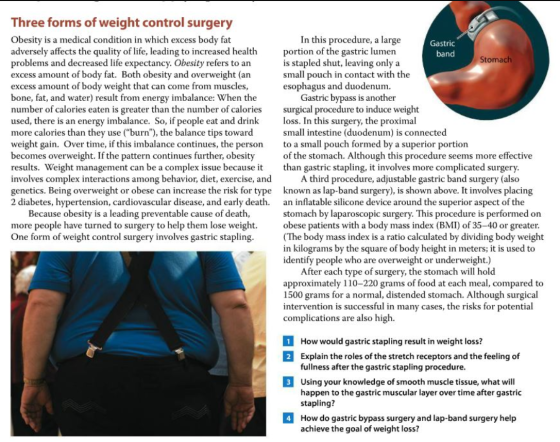 Three forms of weight control surgery Obesity is a medical condition in which excess body fat adversely affects the quality o