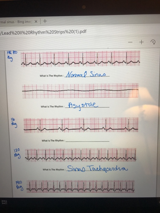 mal sinus - Bing imar x + /Lead%20II%20Rhythm%20Strips%20(1).pdf - + : PR: BO ماما ماما * What is The Rhythm: Normal Sinus Wh