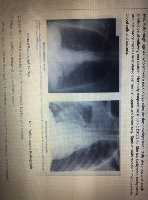 Mrs. Yarborough, age 47, who smokes a pack of cigarettes per day, develops fever, chill, dyspnea, and cough productive of yel