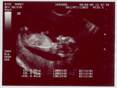 NICE NANCY REX OB/GYN Map4 103200CA(LMP) = 12020 MTZ6.5 GE CN64 Вси DR60 G60 CRL 6 56cm CRL 6 5603 XCRL 6. 85cm 1206D+D 1286D