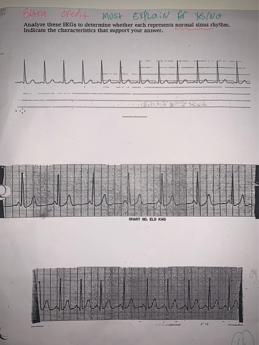 Extra credit Must EXPLain for Yes/No. Analyze these EKGs to determine whether each represents normal sinus rhythm. Indicate t