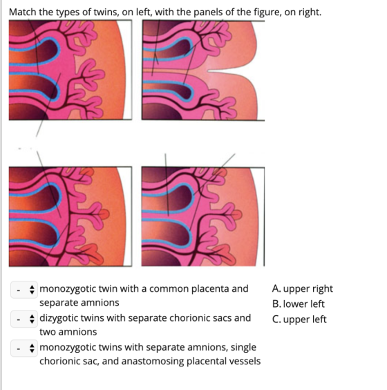 Match the types of twins, on left, with the panels of the figure, on right. - 4 monozygotic twin with a common placenta and s