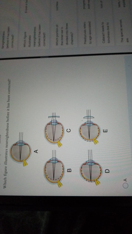 Which figure illustrates nearsightedness before it has been corrected? Blook in bo A nearsightedness coches Which portion of