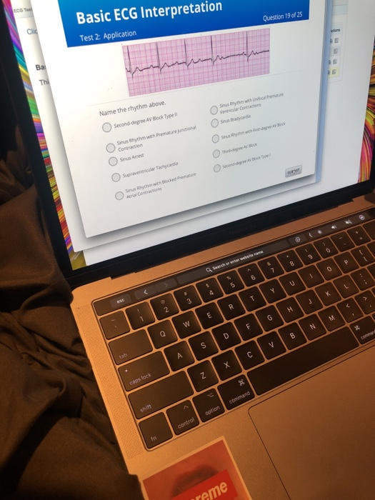 Basic ECG Interpretation Test 2: Application Question 19 of 25 Name the rhythm above Second-degree AV Block Type Sinus Rhythm with Premature Junctional Contration Sinas Rhythm with 3 2. a.
