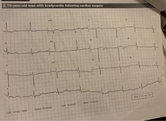 A 70-year-old man with bradycardia following cardiac surgery Chet om my Lamb: 10 mm sec Speed 25 LOC 01156-0006