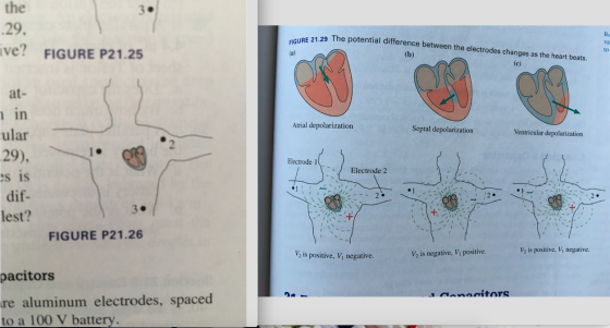 the 29. ve? FIGURE P21.25 3. 2e tntial diference betwen the elecrodes changes as he hartberts Rc va to 29 The potential difference between the electrodes changes as the heart beats FIGURE 21.29 The at- in ular Atrial depolarization Septal depolarization Ventricular depolarization Electrode 1 Electrode 2 s is dif- lest? 3. FIGURE P21.26 V2 is positive, V, negative. V2 is positive, Vi negative V2 is negative, Vi positive. pacitors onanitors re aluminum electrodes, spaced o a 100 V battery.